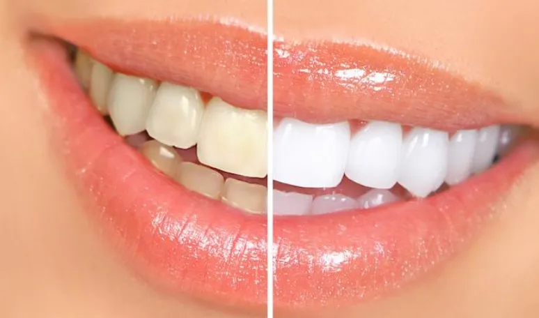 How Professional Teeth Whitening Compares To At Home Kits